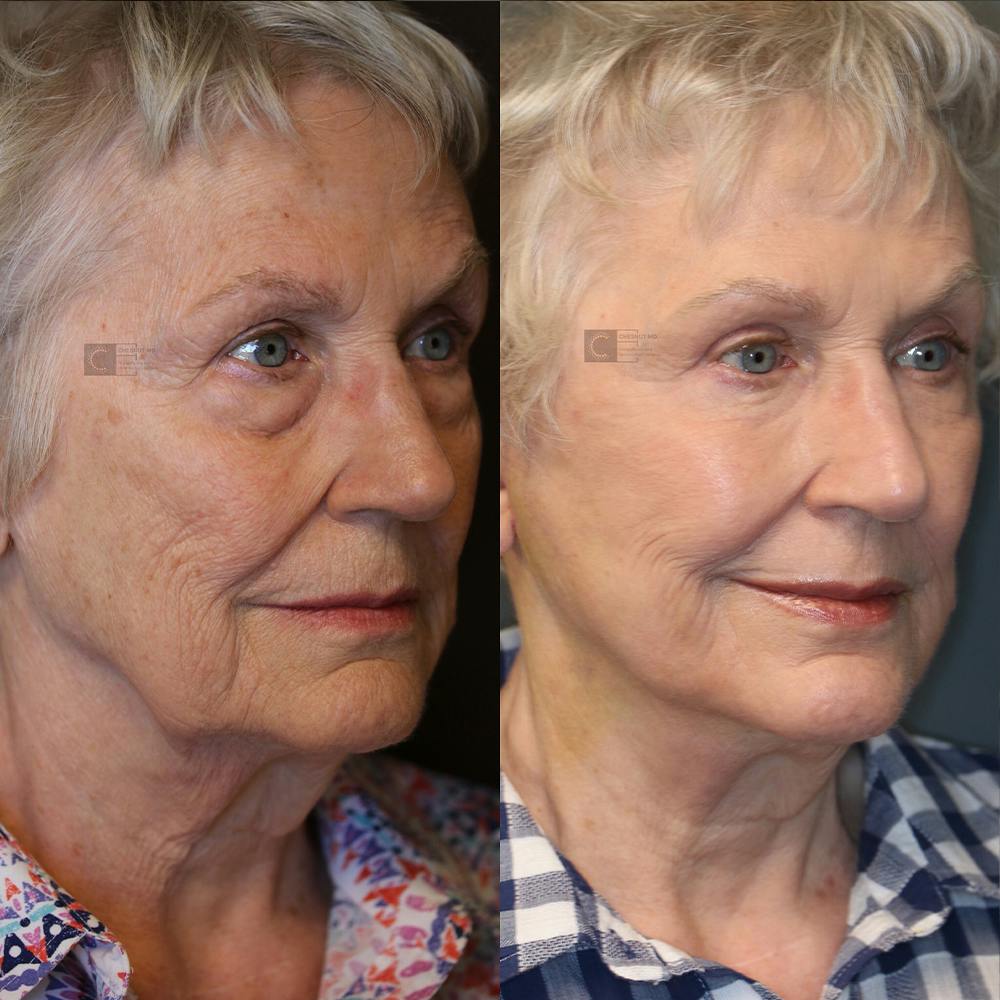 EnigmaLift - Eye Bag Removal Before & After Gallery - Patient 25459473 - Image 2