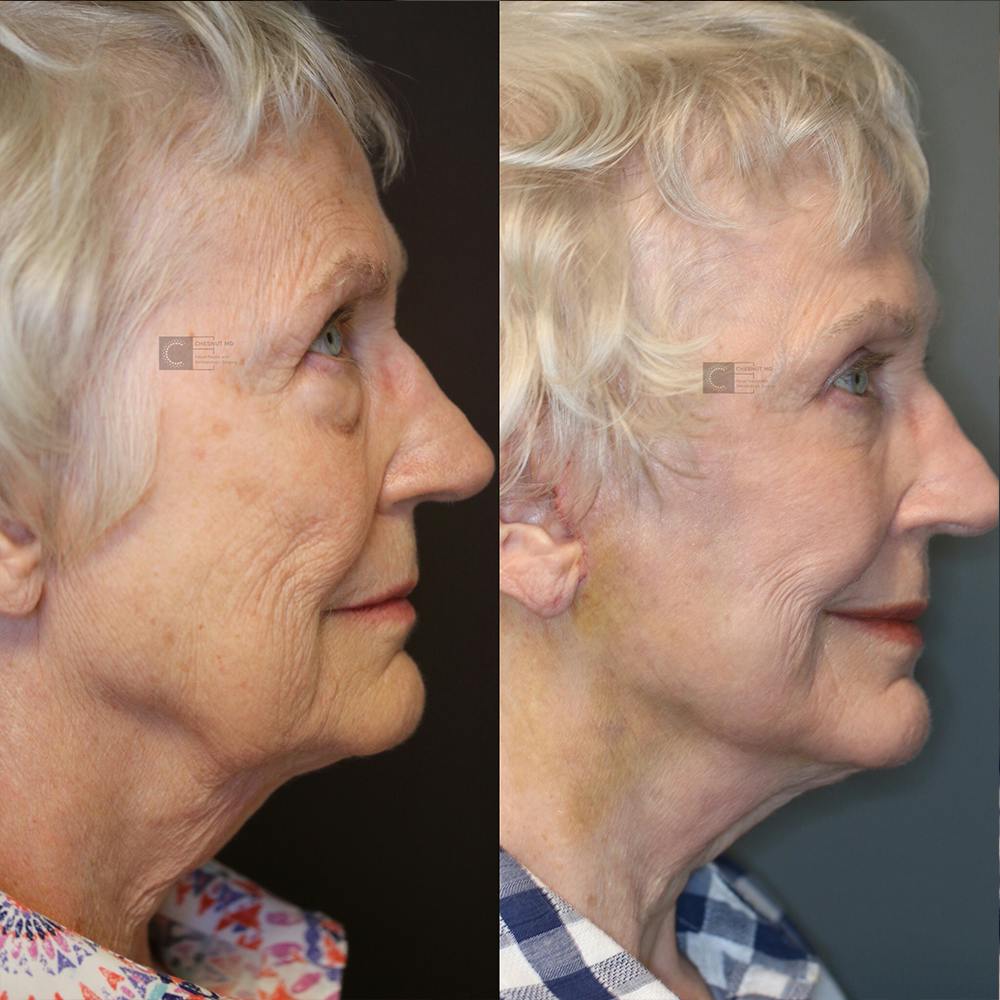 ÔPTIMized Laser Cocktail Before & After Gallery - Patient 25459554 - Image 3