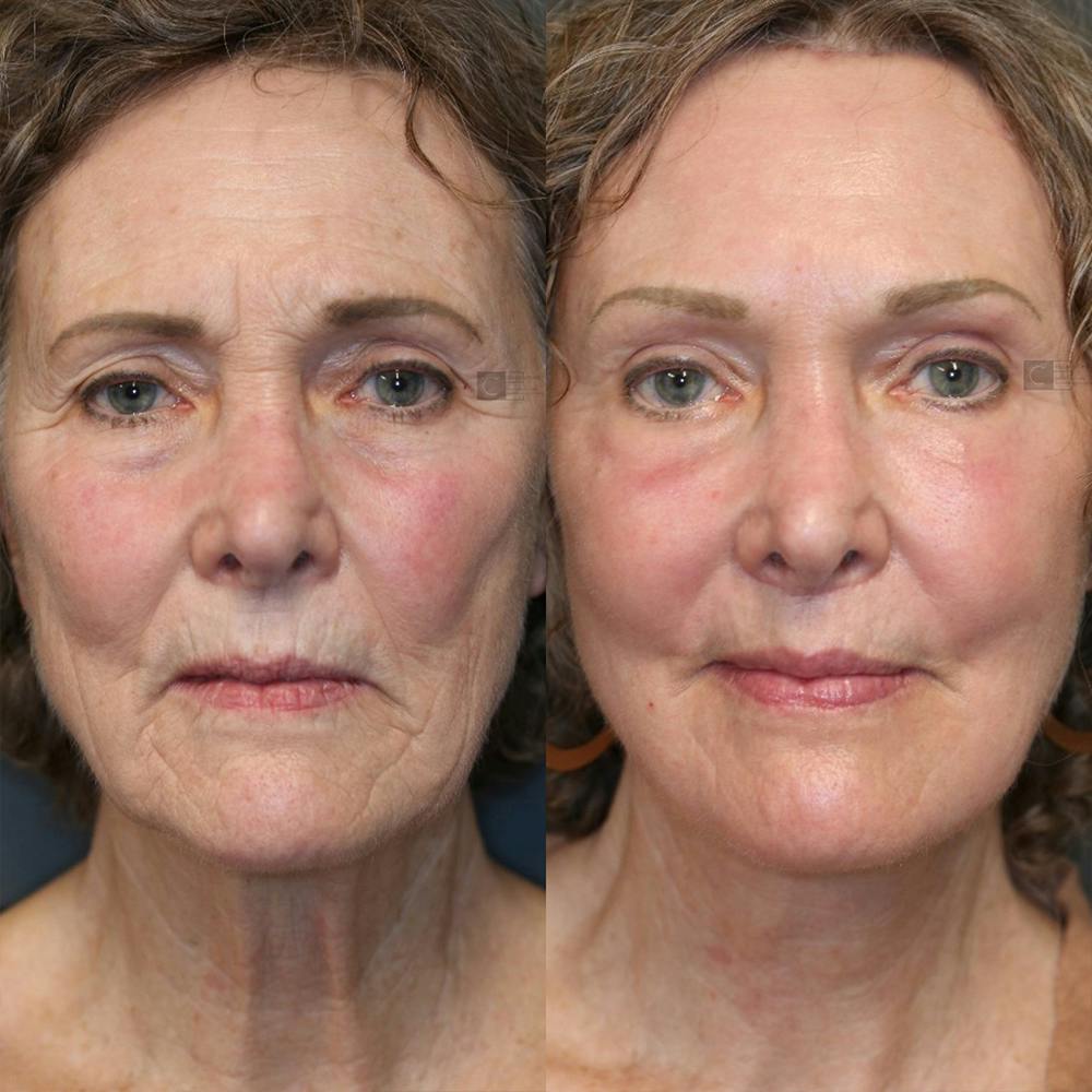 ÔPTIMized Laser Cocktail Before & After Gallery - Patient 25459599 - Image 1