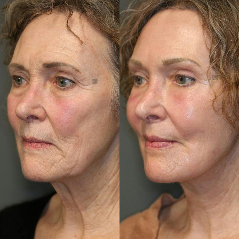 EnigmaLift - Eye Bag Removal Before & After Gallery - Patient 25459607 - Image 2