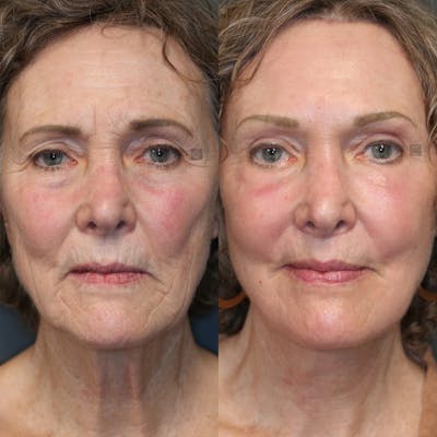 LoveLift - Lip Lift Before & After Gallery - Patient 25459620 - Image 1