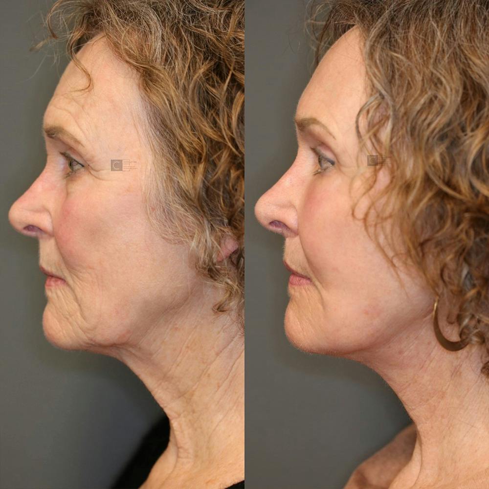 LoveLift - Lip Lift Before & After Gallery - Patient 25459620 - Image 3