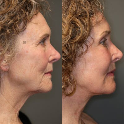 LoveLift - Lip Lift Before & After Gallery - Patient 25459620 - Image 4