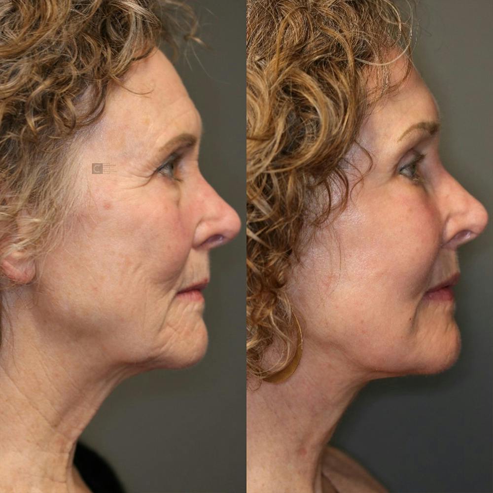 EnigmaLift - Brow Lift Before & After Gallery - Patient 25459632 - Image 4
