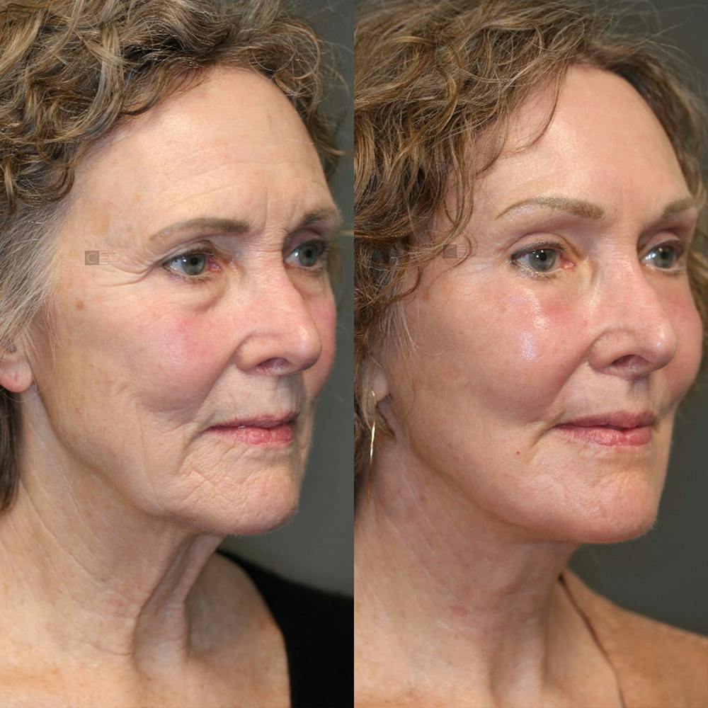 EnigmaLift - Facelift Before & After Gallery - Patient 25459692 - Image 5