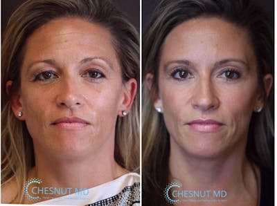  EnigmaLift - Upper Eyelid Surgery Before & After Gallery - Patient 25554983 - Image 1