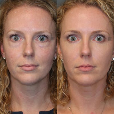 ÔPTIMized Laser Cocktail Before & After Gallery - Patient 32743356 - Image 1