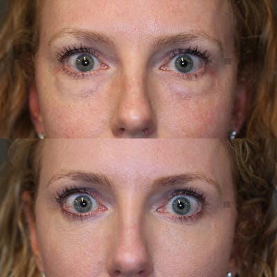 ÔPTIMized Laser Cocktail Before & After Gallery - Patient 32743356 - Image 2