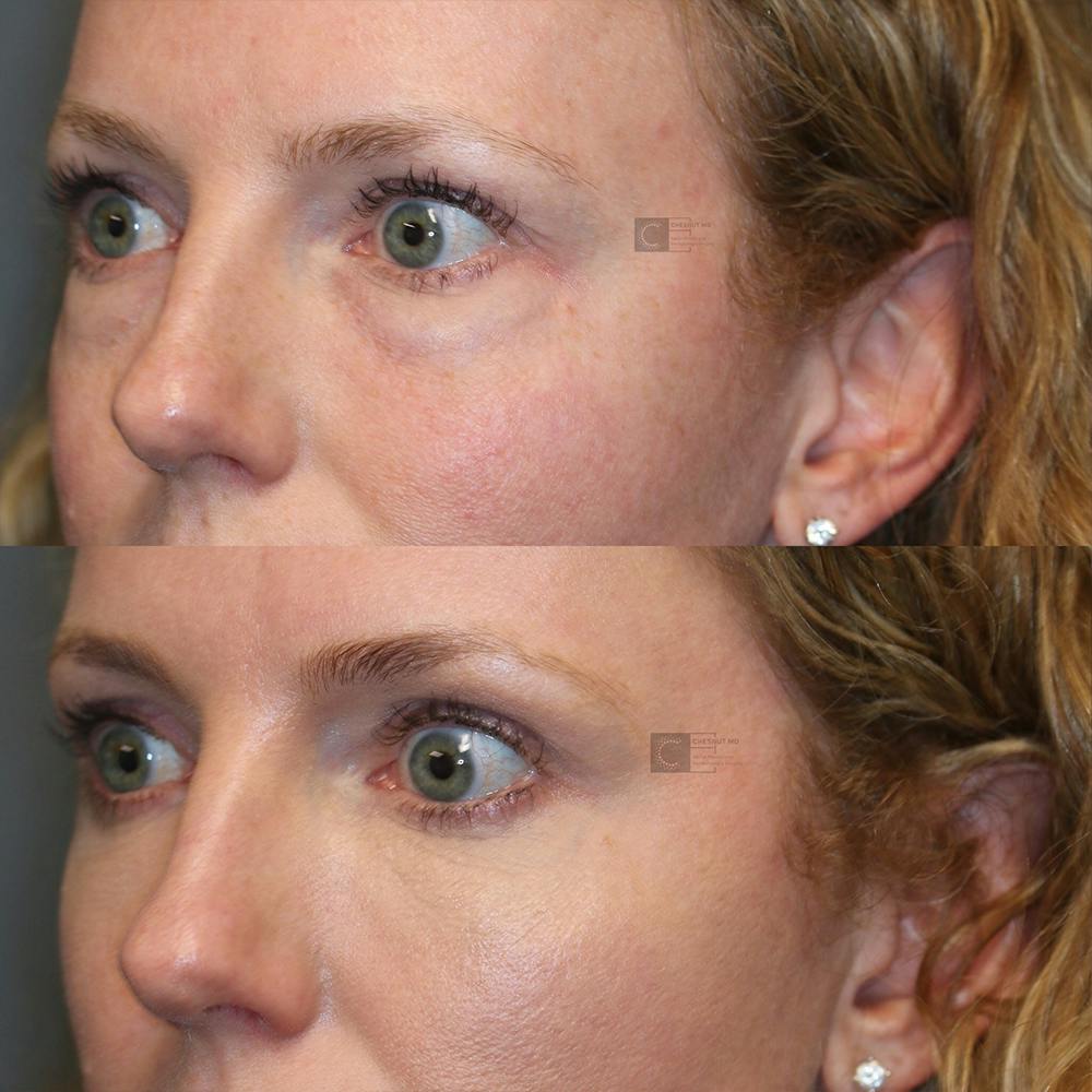 ÔPTIMized Laser Cocktail Before & After Gallery - Patient 32743356 - Image 3