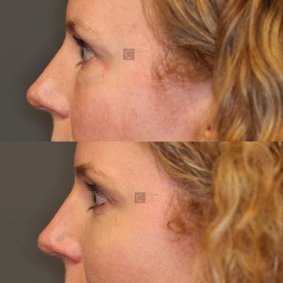 ÔPTIMized Laser Cocktail Before & After Gallery - Patient 32743356 - Image 4