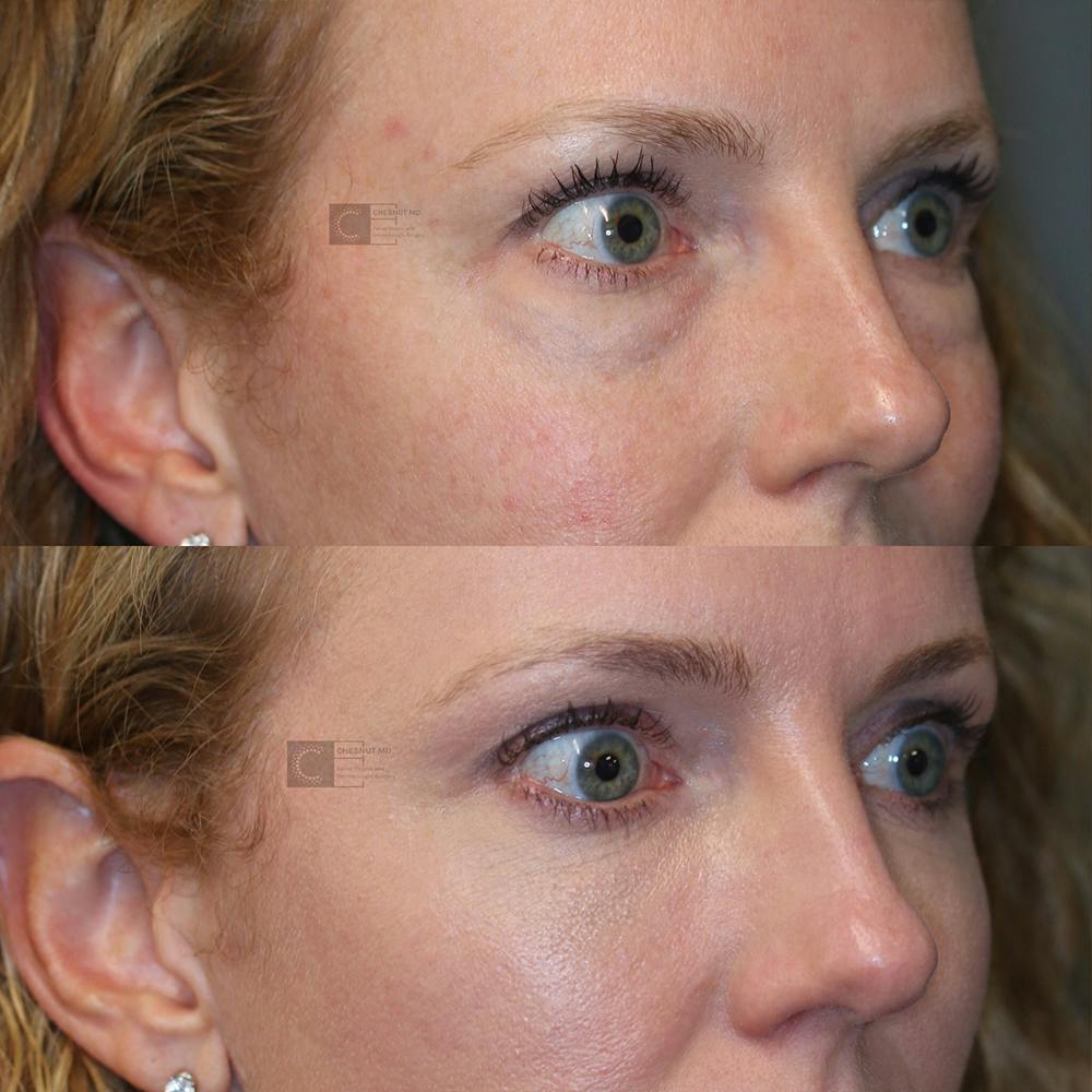 ÔPTIMized Laser Cocktail Before & After Gallery - Patient 32743356 - Image 5