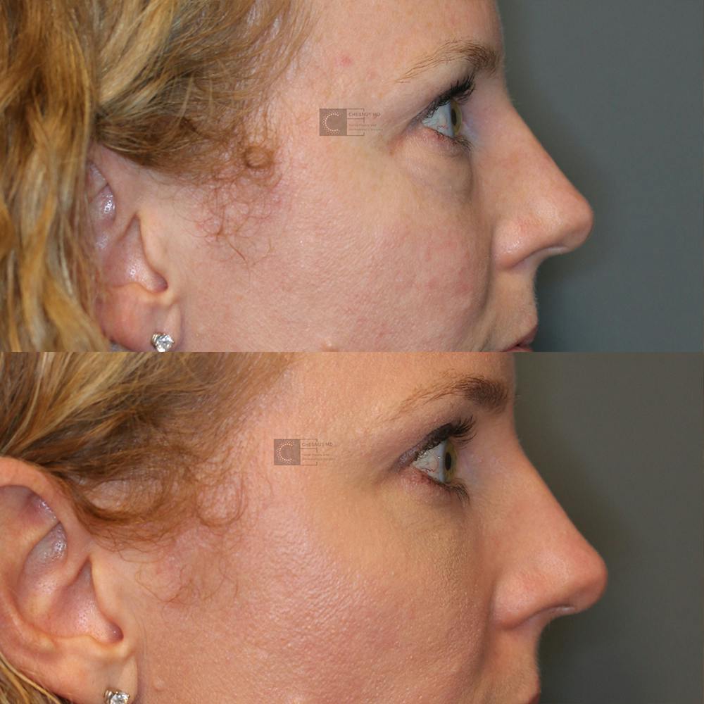ÔPTIMized Laser Cocktail Before & After Gallery - Patient 32743356 - Image 6