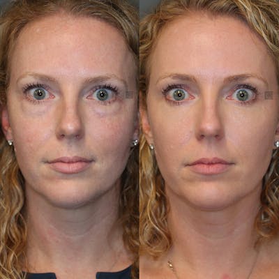 EnigmaLift - Eye Bag Removal Before & After Gallery - Patient 32743367 - Image 1