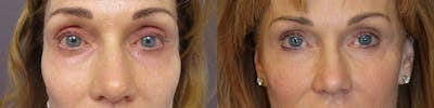 Dermal Fillers Before & After Gallery - Patient 32743404 - Image 1