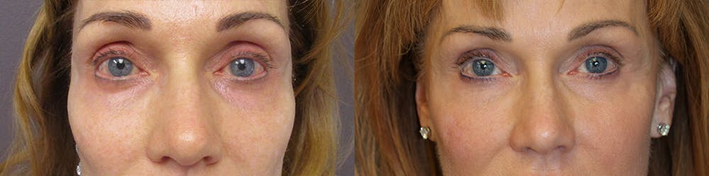 Dermal Fillers Before & After Gallery - Patient 32743404 - Image 1
