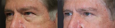 EnigmaLift - Eye Bag Removal Before & After Gallery - Patient 32743418 - Image 1