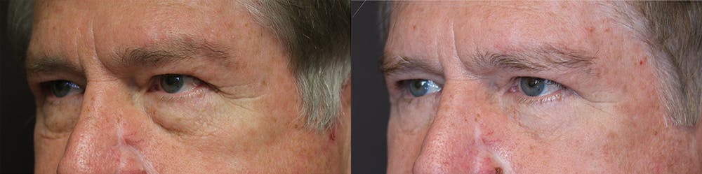 EnigmaLift - Eye Bag Removal Before & After Gallery - Patient 32743418 - Image 1