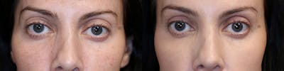  EnigmaLift - Upper Eyelid Surgery Before & After Gallery - Patient 32763141 - Image 1