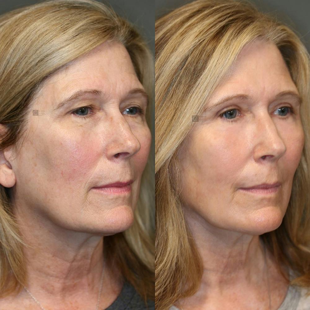 ÔPTIMized Laser Cocktail Before & After Gallery - Patient 32763286 - Image 3