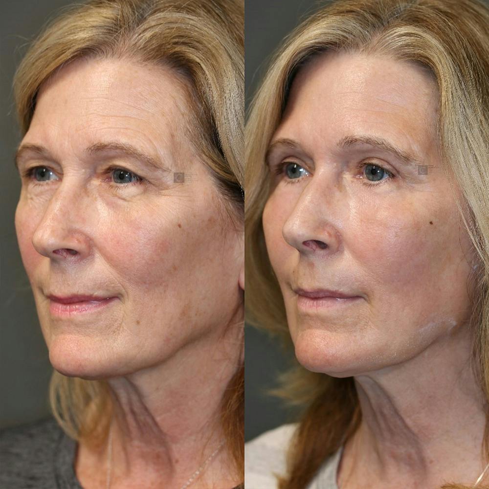 ÔPTIMized Laser Cocktail Before & After Gallery - Patient 32763286 - Image 4