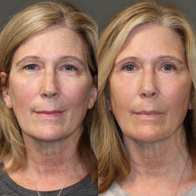 Before & After EnigmaLift Upper Eyelid Surgery
