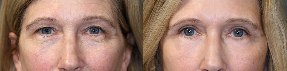 EnigmaLift - Eye Bag Removal Before & After Gallery - Patient 32763359 - Image 2
