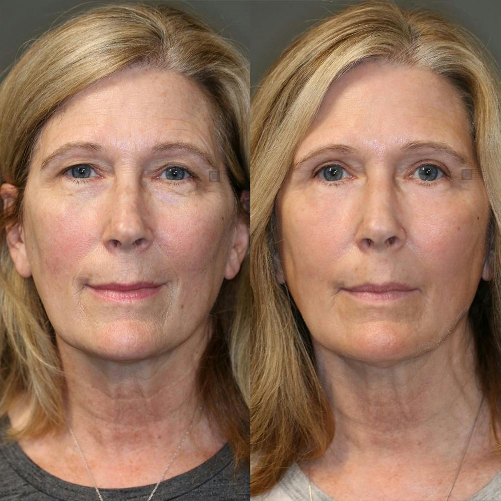  EnigmaLift - Upper Eyelid Surgery Before & After Gallery - Patient 32763411 - Image 1