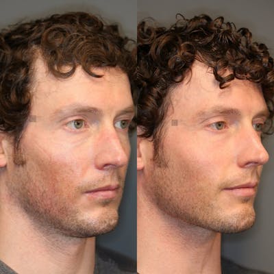 ÔPTIMized Facial Fat Transfer Before & After Gallery - Patient 32775698 - Image 1