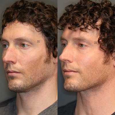 ÔPTIMized Facial Fat Transfer Before & After Gallery - Patient 32775698 - Image 2