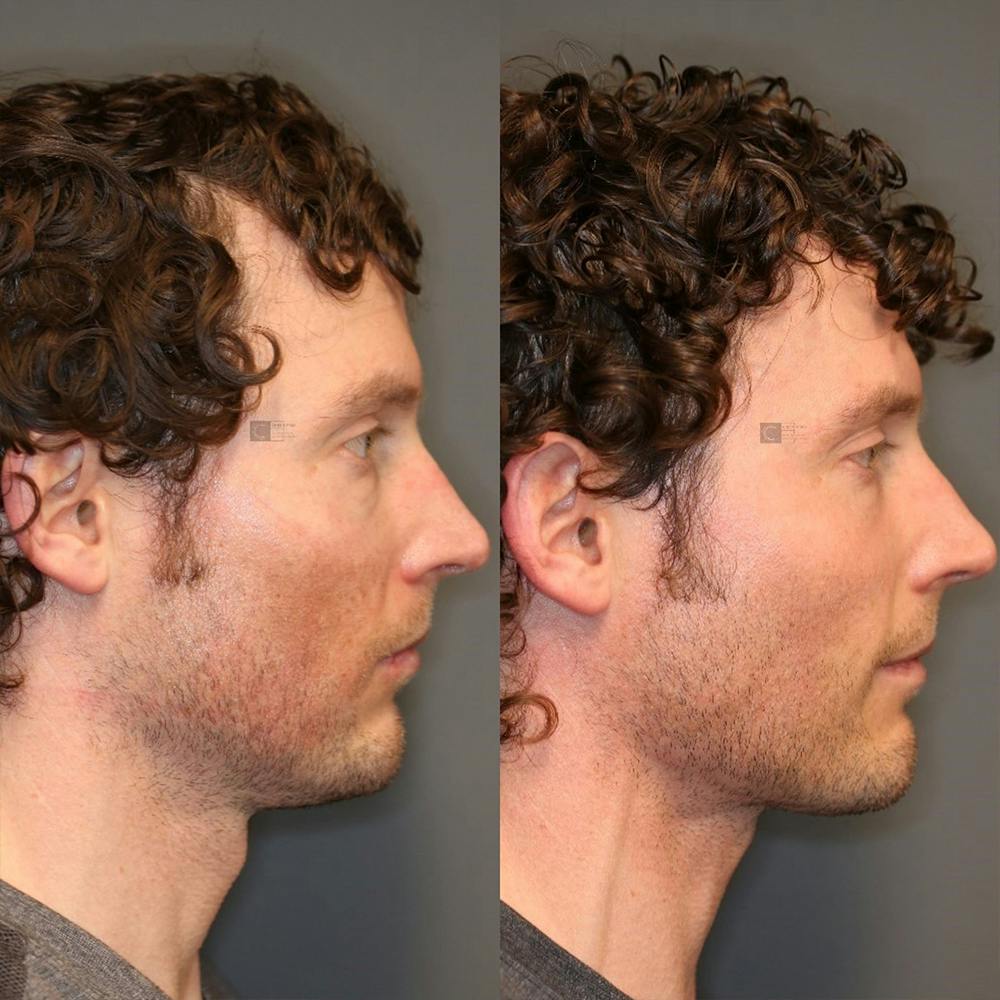 ÔPTIMized Facial Fat Transfer Before & After Gallery - Patient 32775698 - Image 3