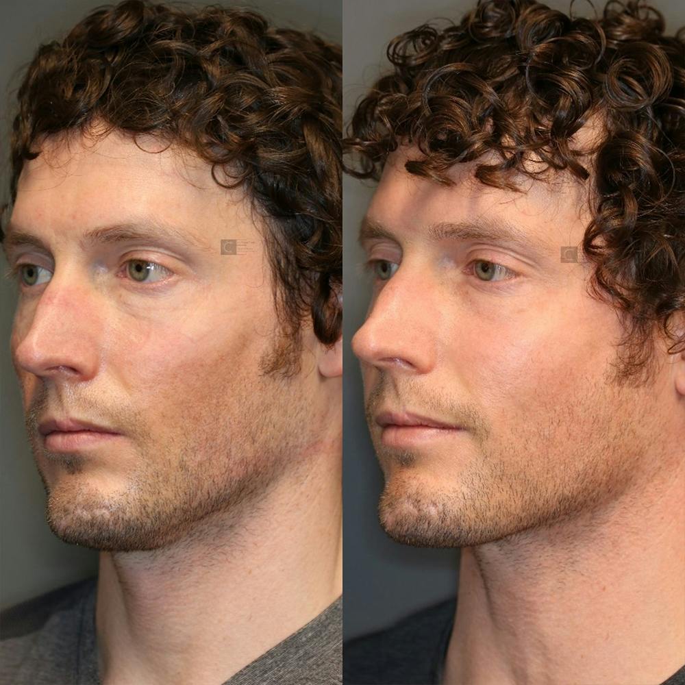 Hair Restoration Before & After Gallery - Patient 32775737 - Image 3