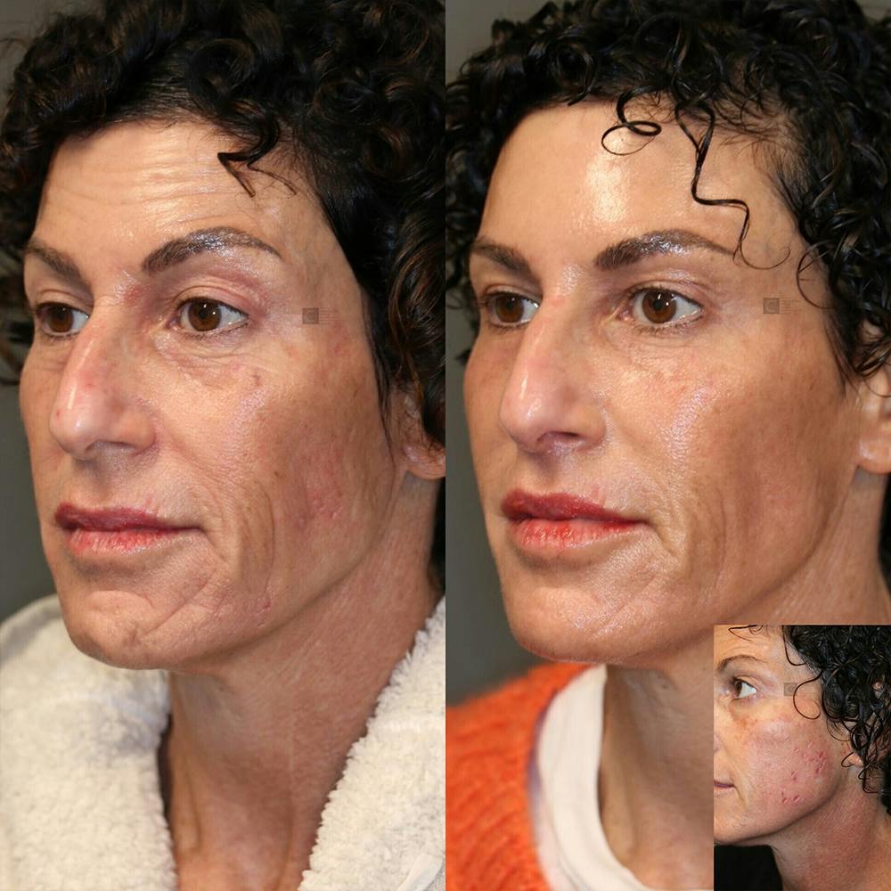 Scar Treatment Before & After Gallery - Patient 36202180 - Image 1