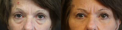 EnigmaLift - Eye Bag Removal Before & After Gallery - Patient 36202562 - Image 1