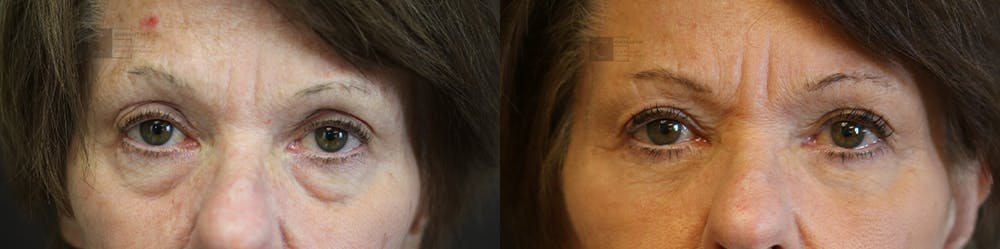 EnigmaLift - Eye Bag Removal Before & After Gallery - Patient 36202562 - Image 1