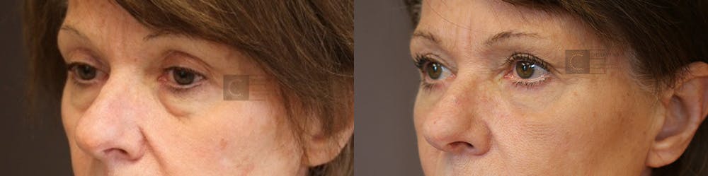 EnigmaLift - Eye Bag Removal Before & After Gallery - Patient 36202562 - Image 2