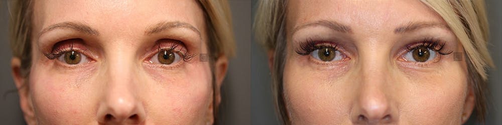  EnigmaLift - Upper Eyelid Surgery Before & After Gallery - Patient 36202806 - Image 1