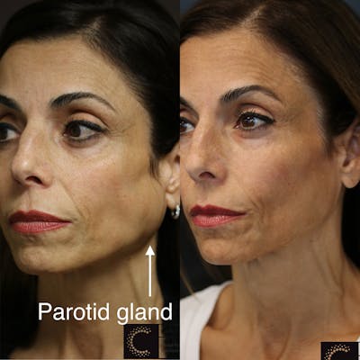 BOTOX, Dysport, Xeomin Before & After Gallery - Patient 36209976 - Image 1