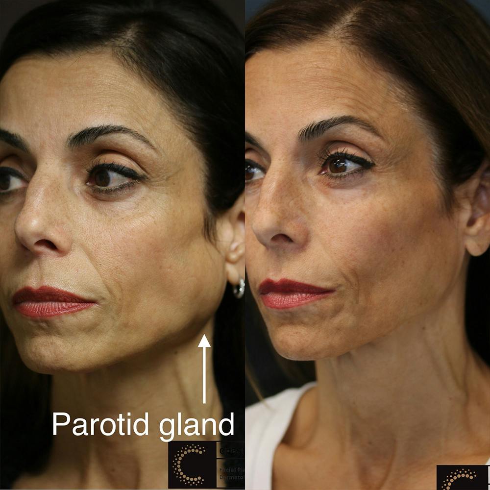 BOTOX, Dysport, Xeomin Before & After Gallery - Patient 36209976 - Image 1