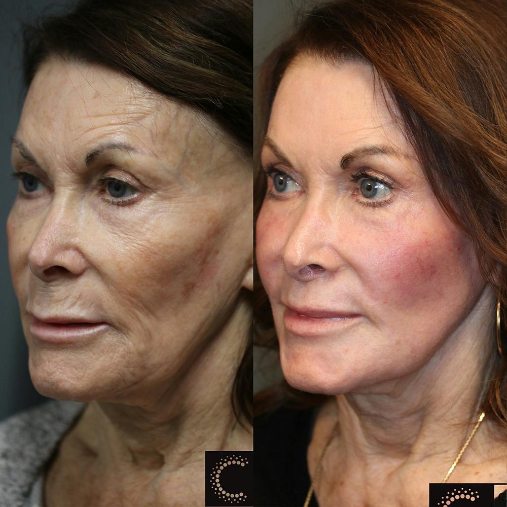 ÔPTIMized Laser Cocktail Before & After Gallery - Patient 36210113 - Image 1