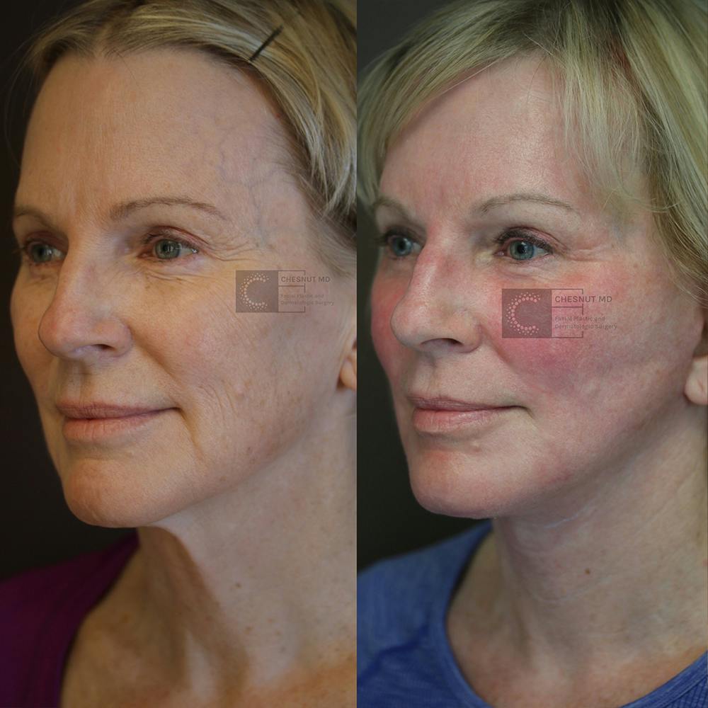 ÔPTIMized Laser Cocktail Before & After Gallery - Patient 36217238 - Image 1