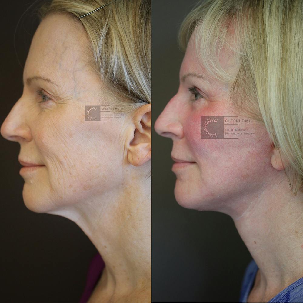 ÔPTIMized Laser Cocktail Before & After Gallery - Patient 36217238 - Image 2