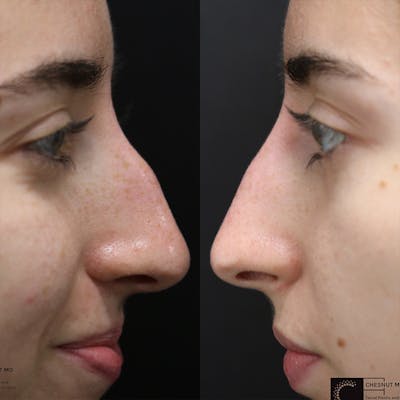 Dermal Fillers Before & After Gallery - Patient 36443844 - Image 1