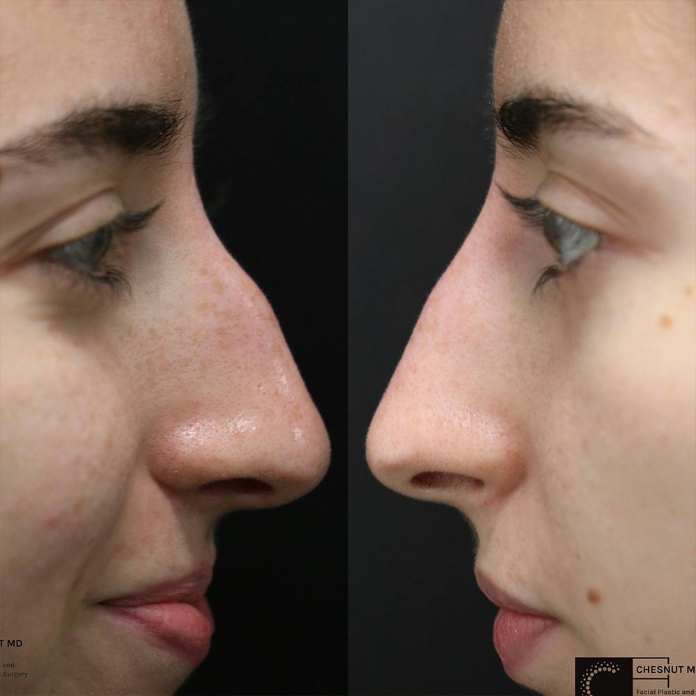Dermal Fillers Before & After Gallery - Patient 36443844 - Image 1