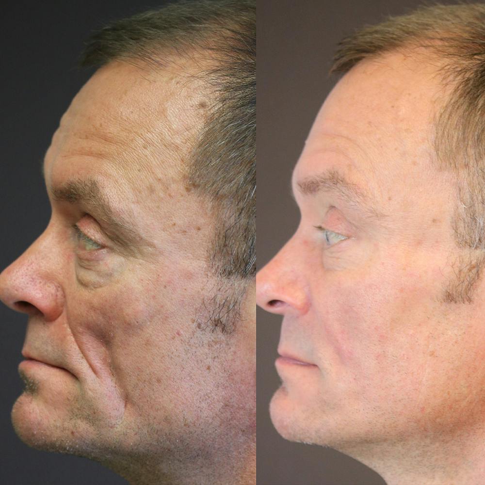 Dermal Fillers Before & After Gallery - Patient 36451968 - Image 1