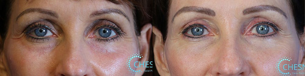 Dermal Fillers Before & After Gallery - Patient 36480159 - Image 1