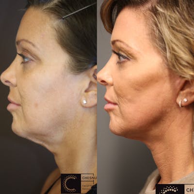 EnigmaLift - Facelift Before & After Gallery - Patient 36517592 - Image 1