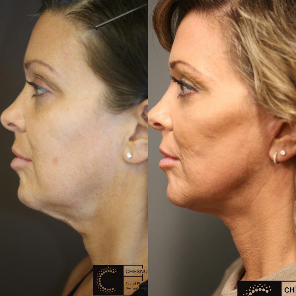 EnigmaLift - Facelift Before & After Gallery - Patient 36517592 - Image 1