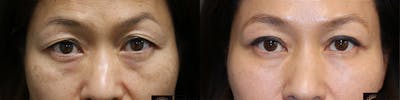 Dermal Fillers Before & After Gallery - Patient 36518782 - Image 1
