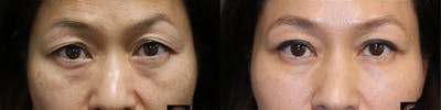  EnigmaLift - Upper Eyelid Surgery Before & After Gallery - Patient 36518829 - Image 1