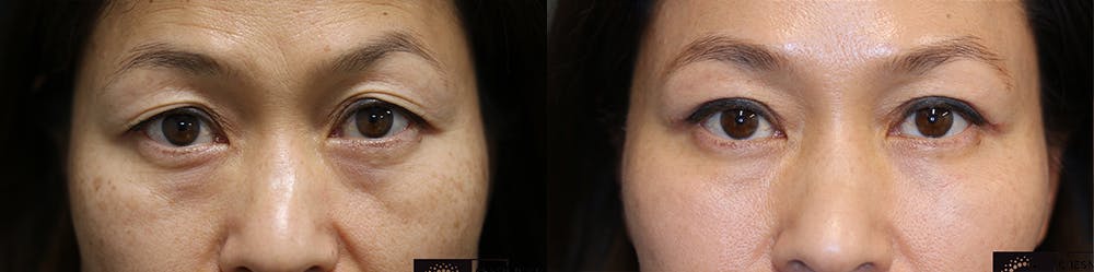  EnigmaLift - Upper Eyelid Surgery Before & After Gallery - Patient 36518829 - Image 1